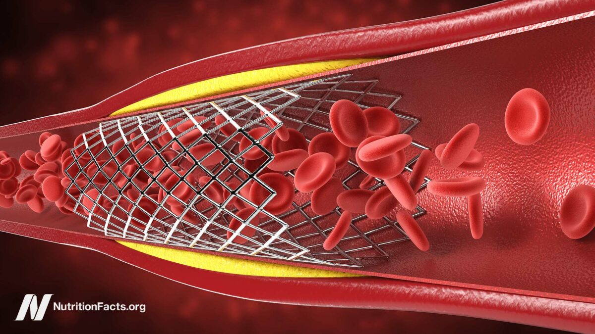 graphic of a cross-section of an artery with a stent in it